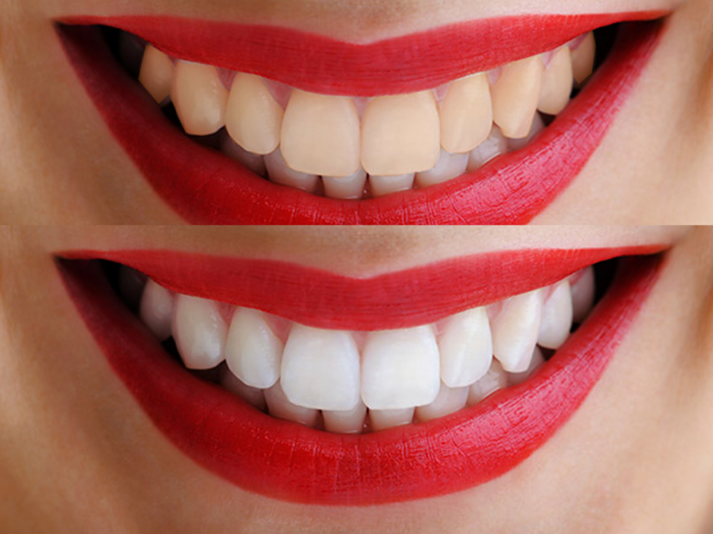 Отбеливание зубов Opalescence Томск Короленко стоматологический аппарат цена